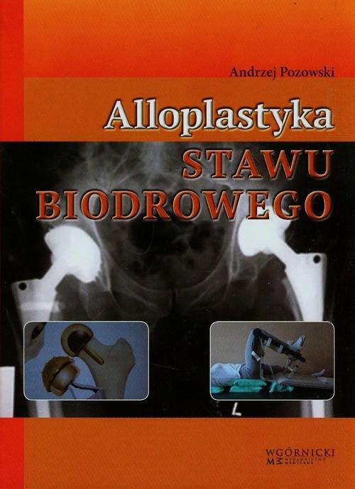 

Alloplastyka stawu biodrowego Pozowski Andrzej