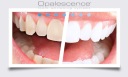 OPALESCENCE 4x% 16_3в1 ГЕЛЬ ДЛЯ ОТБЕЛИВАНИЯ ЗУБОВ