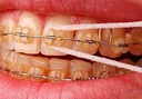 ZUBNÁ NIŤ ORAL-B SUPERFLOSS PRE FOTOAPARÁTY, KORUNKY A MOSTÍKY 50 EPIZÓD Ďalšie vlastnosti ortodontické