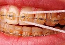 ZUBNÍ NIT ORAL-B SUPERFLOSS PRO FOTOAPARÁTY, KORUNKY A MŮSTKY, 50 ÚSEKŮ Další funkce ortodontické