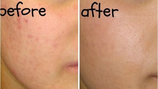 Revitol Scar Cream от шрамов, шрамов от прыщей.