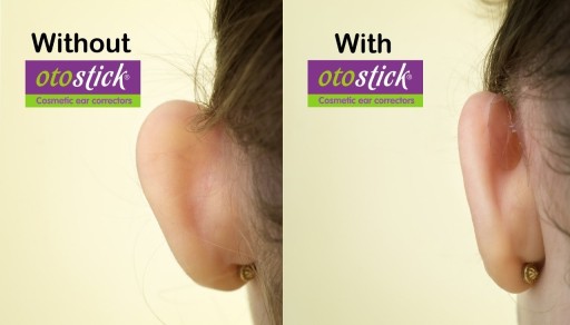 Otostick Aesthetic Ear Correctors 8 шт. + БЕСПЛАТНО